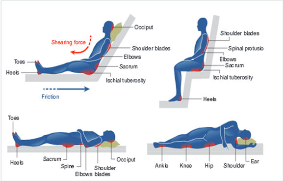 Pressurepoints